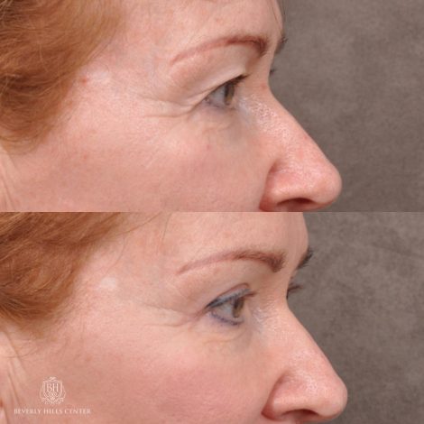 Beverly Hills Center Female Patient Before and After Upper Blepharoplasty with Fat Repositioning and Contouring