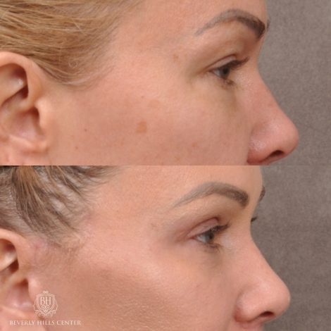 Beverly Hills Center Female Patient Before and After AuraLyft