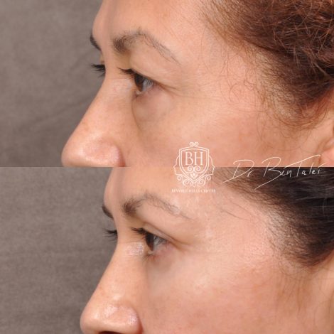Beverly Hills Center Female Patient Before and After Upper & Lower Blepharoplasty with Fat Repositioning and Fat Grafting