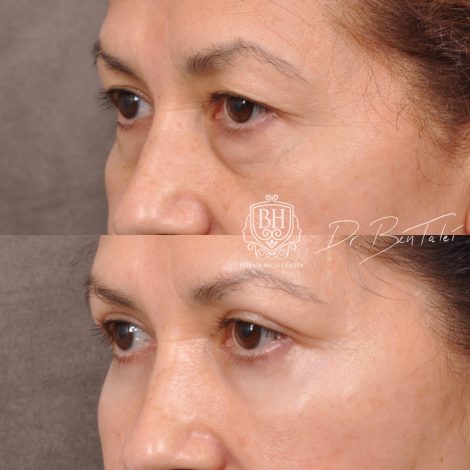 Beverly Hills Center Female Patient Before and After Upper & Lower Blepharoplasty with Fat Repositioning and Fat Grafting