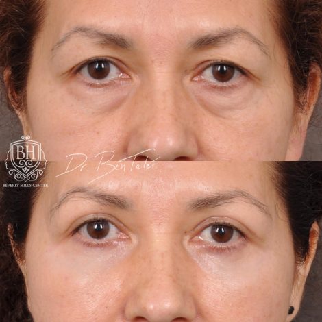 Beverly Hills Center Female Patient Before and After Upper & Lower Blepharoplasty with Fat Repositioning and Fat Grafting