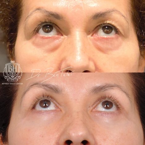 Beverly Hills Center Female Patient Before and After Upper & Lower Blepharoplasty with Fat Repositioning and Fat Grafting