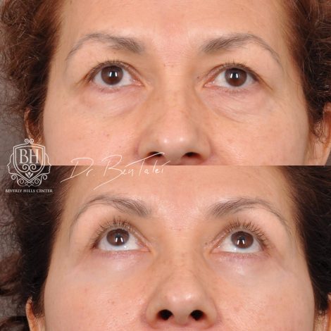 Beverly Hills Center Female Patient Before and After Upper & Lower Blepharoplasty with Fat Repositioning and Fat Grafting