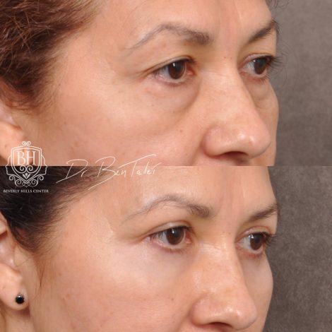 Beverly Hills Center Female Patient Before and After Upper & Lower Blepharoplasty with Fat Repositioning and Fat Grafting