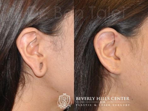 Beverly Hills Center Female Patient Before and After Gauge Piercing / Stretched Ear Lobe Repair