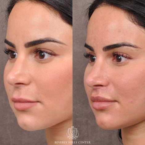 Beverly Hills Center Female Patient Before and After Modified Upper Lip Lift with Deep Plane Release