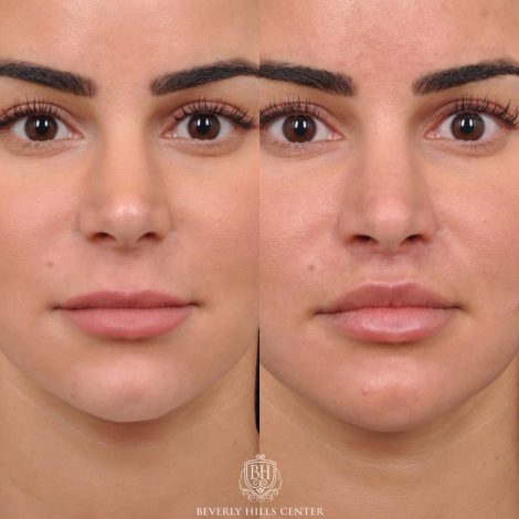 Beverly Hills Center Female Patient Before and After Modified Upper Lip Lift with Deep Plane Release
