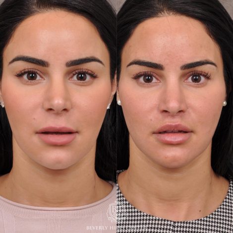 Beverly Hills Center Female Patient Before and After Modified Upper Lip Lift with Deep Plane Release