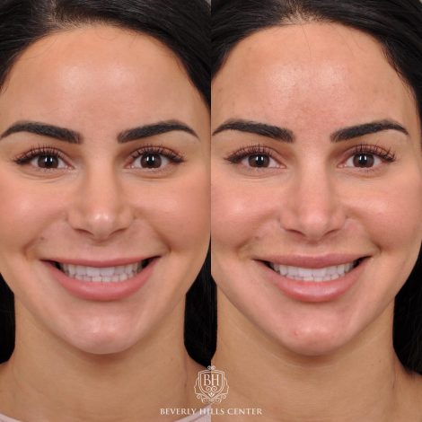 Beverly Hills Center Female Patient Before and After Modified Upper Lip Lift with Deep Plane Release