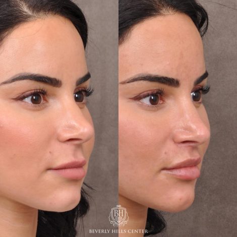 Beverly Hills Center Female Patient Before and After Modified Upper Lip Lift with Deep Plane Release