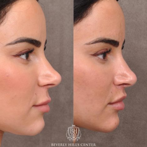 Beverly Hills Center Female Patient Before and After Modified Upper Lip Lift with Deep Plane Release