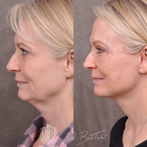 Beverly Hills Center Female Patient Before and Afte Auralyft & Upper Bleph