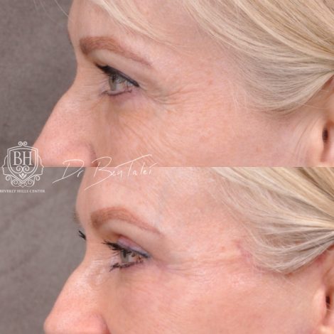 Beverly Hills Center Female Patient Before and After Auralyft & Upper Bleph