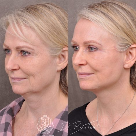 Beverly Hills Center Female Patient Before and Afte Auralyft & Upper Bleph