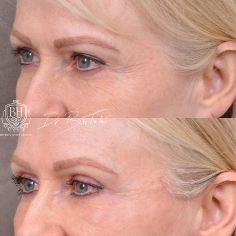 Beverly Hills Center Female Patient Before and After Auralyft & Upper Bleph