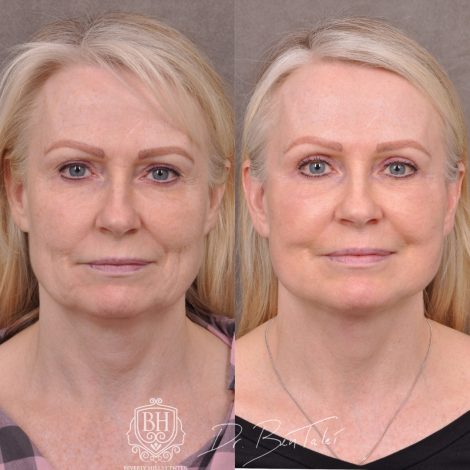 Beverly Hills Center Female Patient Before and Afte Auralyft & Upper Bleph