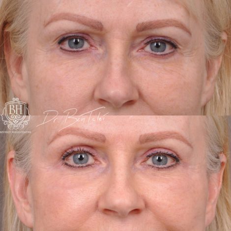 Beverly Hills Center Female Patient Before and After Auralyft & Upper Bleph