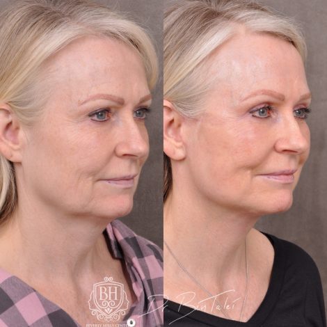 Beverly Hills Center Female Patient Before and Afte Auralyft & Upper Bleph