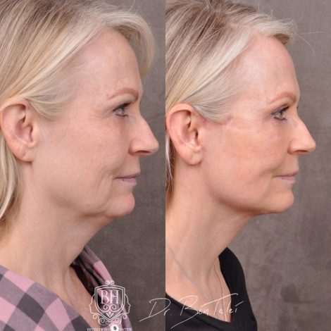 Beverly Hills Center Female Patient Before and Afte Auralyft & Upper Bleph