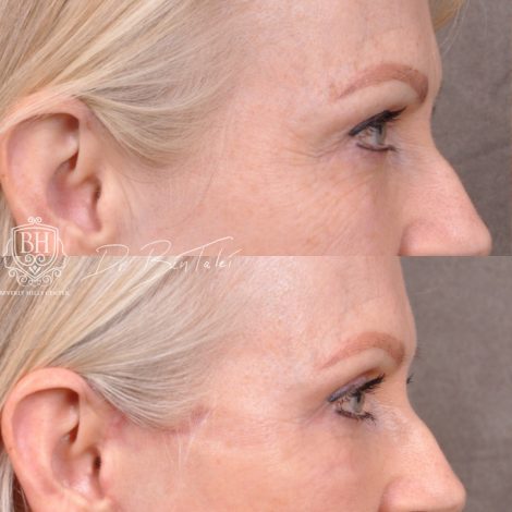 Beverly Hills Center Female Patient Before and After Auralyft & Upper Bleph