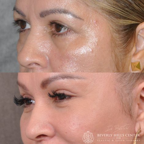 Beverly Hills Center Female Patient Auralyft, Browlift, Lip lift, Upper Bleph & Earlobe Reduction