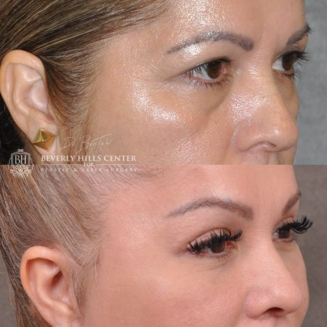 Beverly Hills Center Female Patient Auralyft, Browlift, Lip lift, Upper Bleph & Earlobe Reduction
