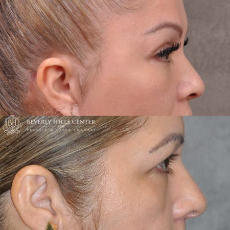 Beverly Hills Center Female Patient Auralyft, Browlift, Lip lift, Upper Bleph & Earlobe Reduction