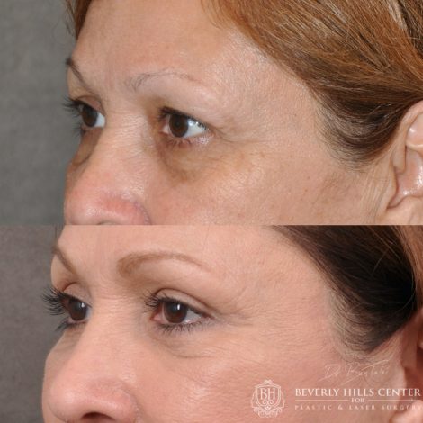 Beverly Hills Center Female Patient Before and After Facial Rejuvenation Procedures