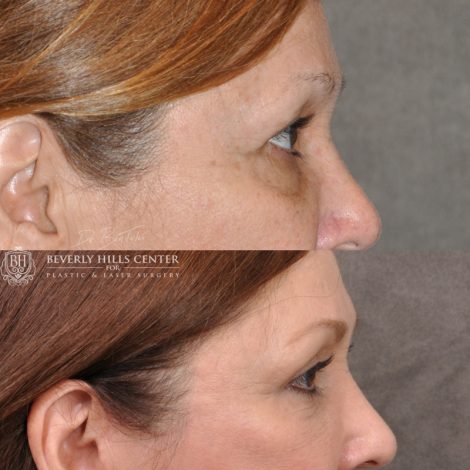 Beverly Hills Center Female Patient Before and After Facial Rejuvenation Procedures
