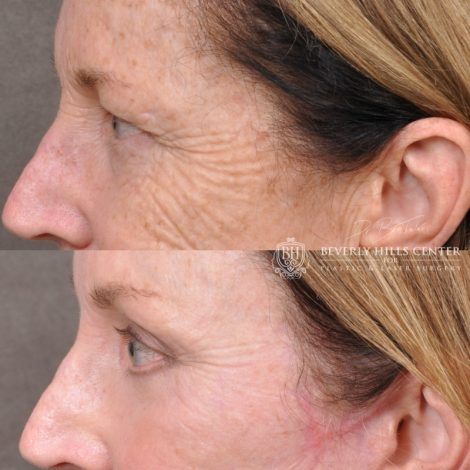 Beverly Hills Center Female Patient Before and After Facial Rejuvenation Procedures
