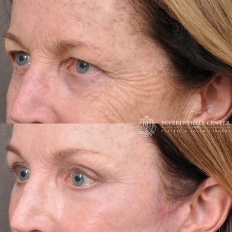 Beverly Hills Center Female Patient Before and After Facial Rejuvenation Procedures