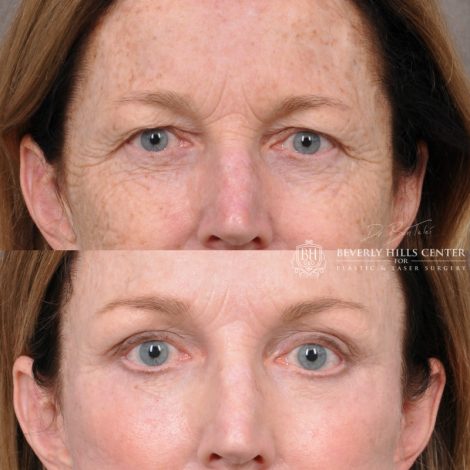 Beverly Hills Center Female Patient Before and After Facial Rejuvenation Procedures