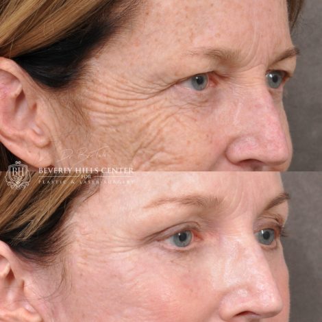 Beverly Hills Center Female Patient Before and After Facial Rejuvenation Procedures