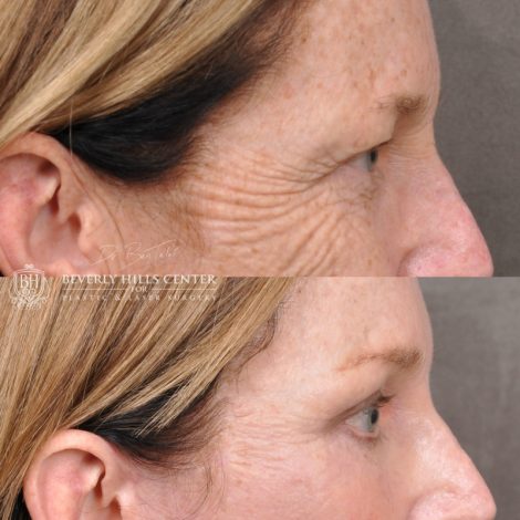 Beverly Hills Center Female Patient Before and After Facial Rejuvenation Procedures