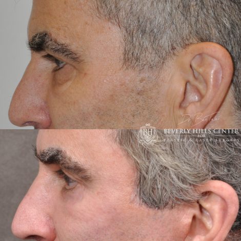 Beverly Hills Center Male Patient Before and After Facial Rejuvenation Procedures