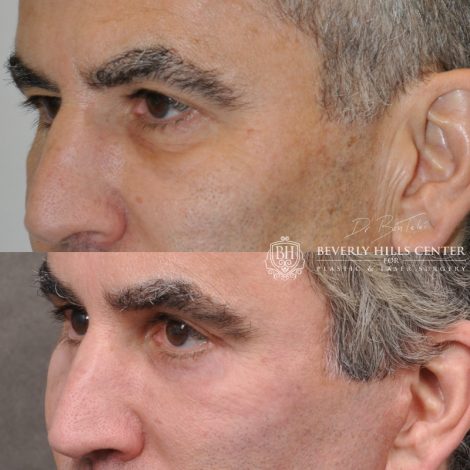 Beverly Hills Center Male Patient Before and After Facial Rejuvenation Procedures