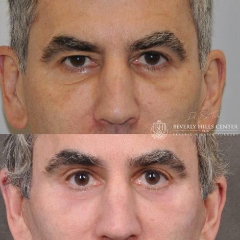 Beverly Hills Center Male Patient Before and After Facial Rejuvenation Procedures