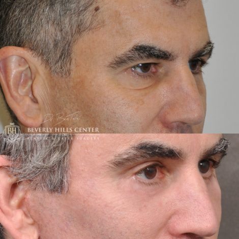 Beverly Hills Center Male Patient Before and After Facial Rejuvenation Procedures