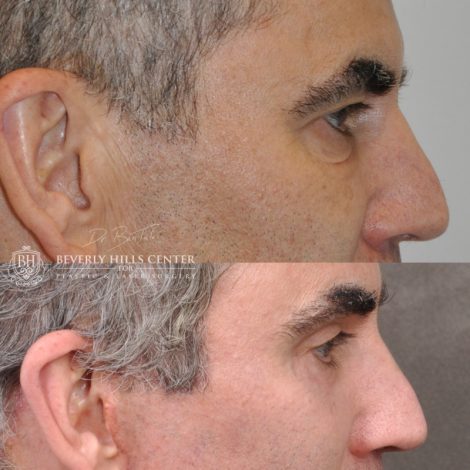 Beverly Hills Center Male Patient Before and After Facial Rejuvenation Procedures