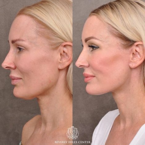 Beverly Hills Center Female Patient Before and After Auralyft Upper Bleph