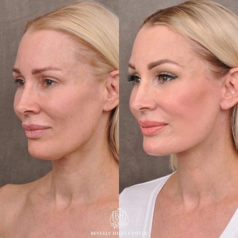 Beverly Hills Center Female Patient Before and After Auralyft Upper Bleph