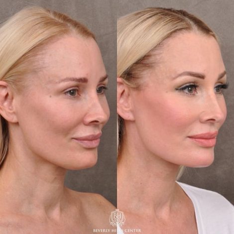 Beverly Hills Center Female Patient Before and After Auralyft Upper Bleph