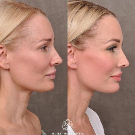 Beverly Hills Center Female Patient Before and After Auralyft Upper Bleph