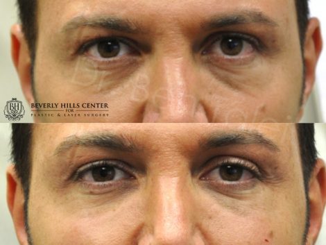 Beverly Hills Center Male Patient Before and After Restylane