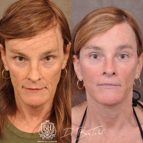 Beverly Hills Center Transgender Patient Before and After AuraLyft Revision Procedure