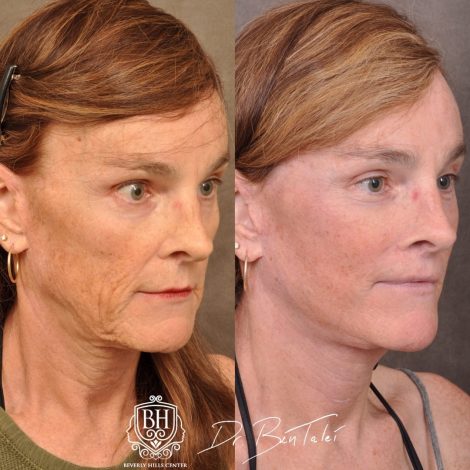 Beverly Hills Center Transgender Patient Before and After AuraLyft Revision Procedure