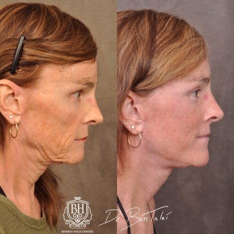 Beverly Hills Center Transgender Patient Before and After AuraLyft Revision Procedure