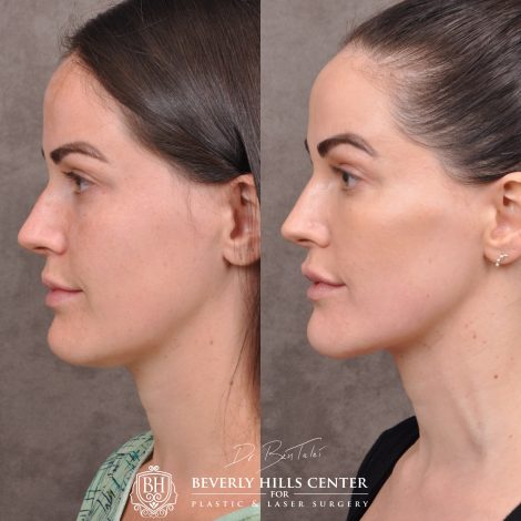 Beverly Hills Center Female Patient Before and After Weekend Necklift Procedure