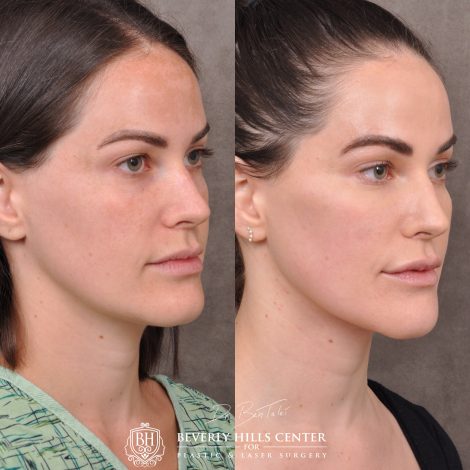 Beverly Hills Center Female Patient Before and After Weekend Necklift Procedure