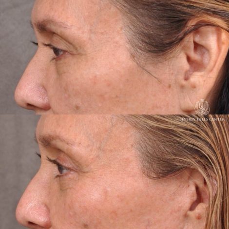 Beverly Hills Center Female Patient Before and After Brow Lift, Upper and Lower Bleph and Comprehensive Auralyft with Ptosis Repair